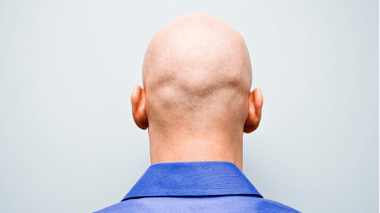 A bald head with a smooth finish, showcasing the result of using a Roundry for a confident, modern bald styling.