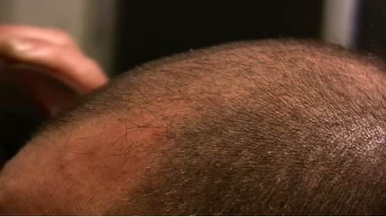 This patchy scalp shave is one sign your head shaver is worn out.